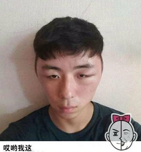 帅哥染头发后头肿脸胀 自拍记录全过程 医生都看呆