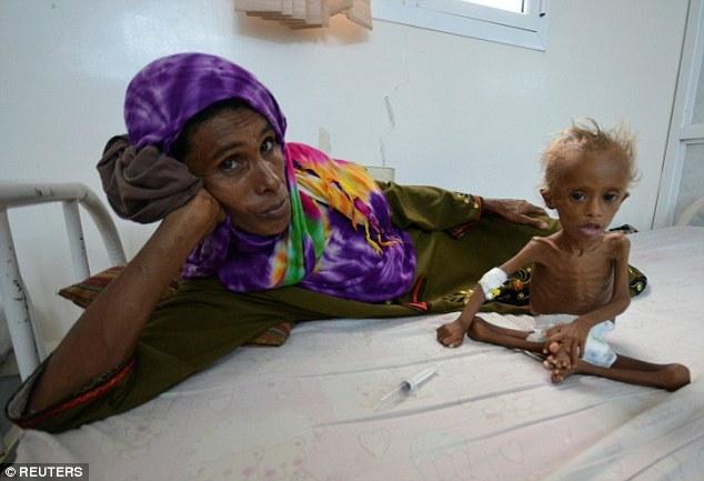 也门男婴获救瘦成皮包骨 网友大呼心疼