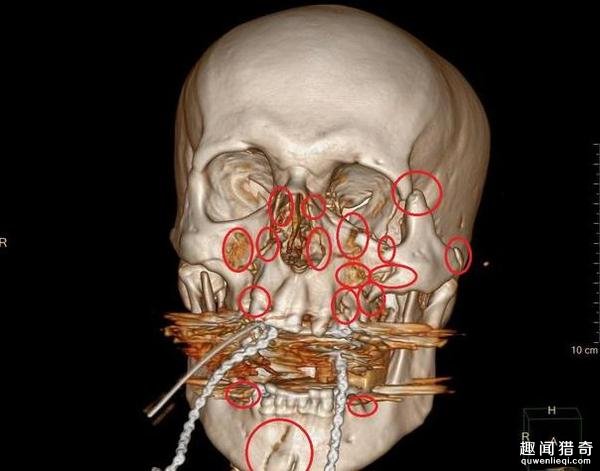 交通事故。肋骨骨折和胸骨,腰椎骨折。像这种