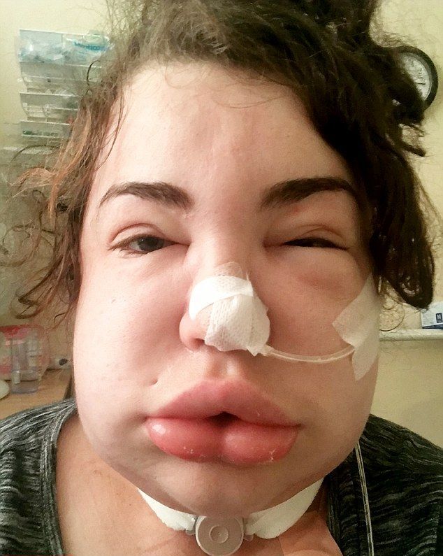 患癌女子被误诊感冒 喉咙肿至两倍或将无法说